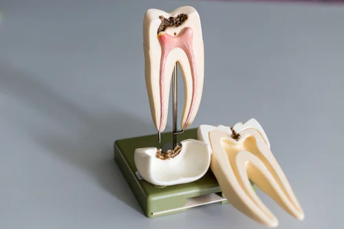 Root Canal.jpg