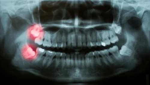 wisdom teeth.jpg