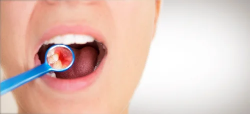 gumdisease.jpg