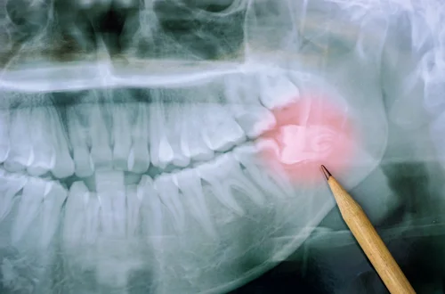 wisdomteeth.jpg