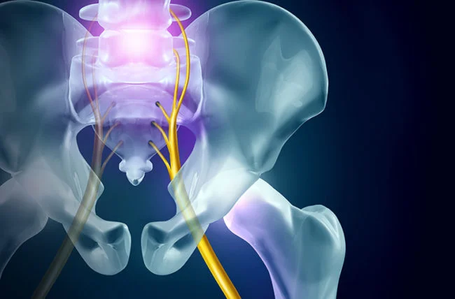 The medical term for sciatica is lumbar radiculopathy and refers to disease involving the lumbar spinal nerve root, typically caused by a compression of the spinal nerve root.