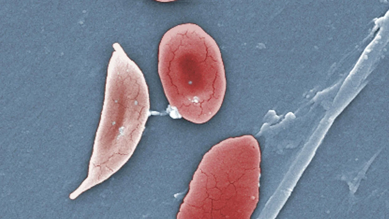 Sickle Cell Drug Endari Wins FDA Approval, First New Drug In 20 Years