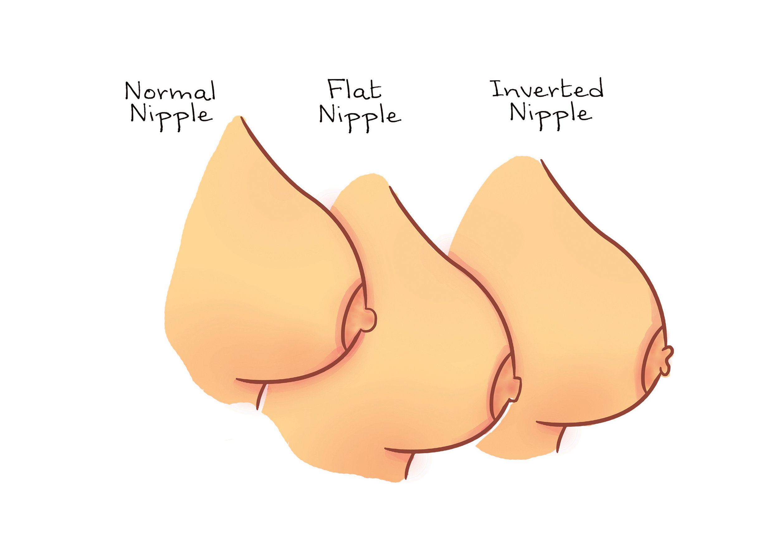 Inverted Nipples