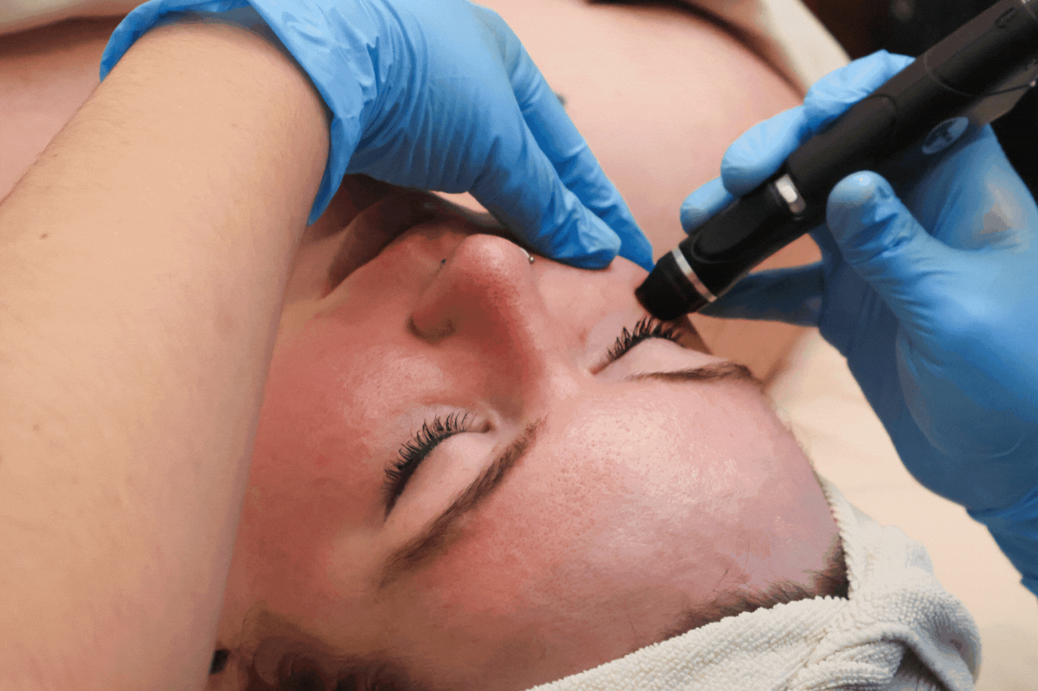 A woman receiving a hydrafacial treatment on her under-eyes and lips.
