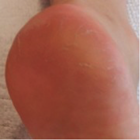 Condition 4 Weeks Later with regular use of the Footlogix products.