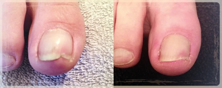 BEFORE/AFTER (20 weeks PACT treatment)