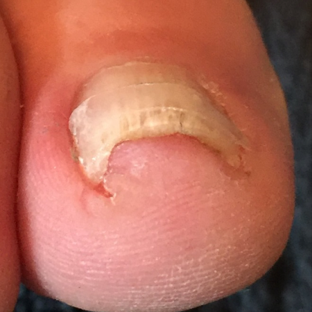 Right Foot: Third Visit, Sept 2016