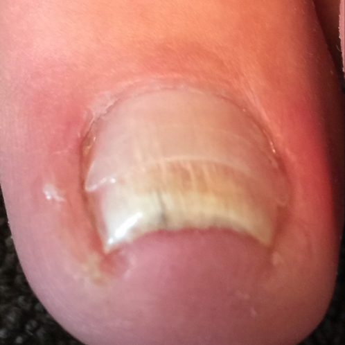 Left Foot: Second Visit, June 2016