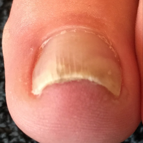 Left Foot: Third Visit, Sept 2016