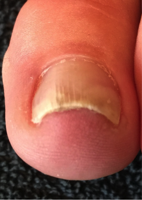 Left Foot: Third Visit, Sept 2016