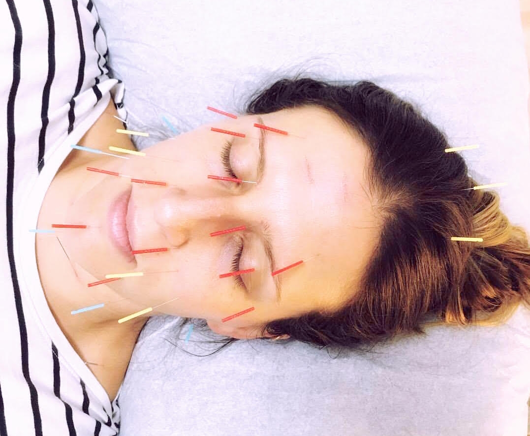Facial Acupuncture Rejuvenation
