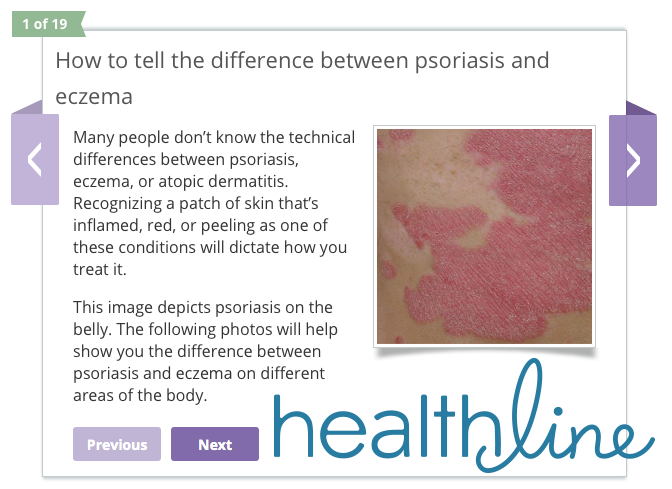Psoriasis and Eczema