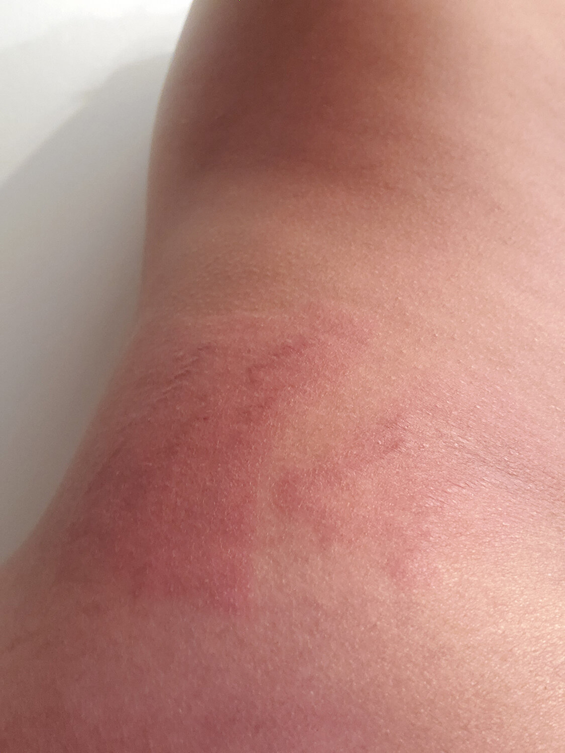 Laser Stretch Mark Reduction Session 1d right.jpg
