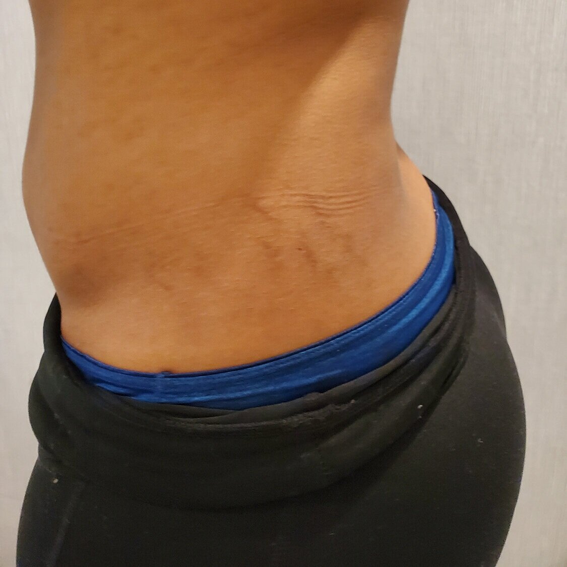 Laser+Stretch+Mark+Reduction+Before+1a.jpg