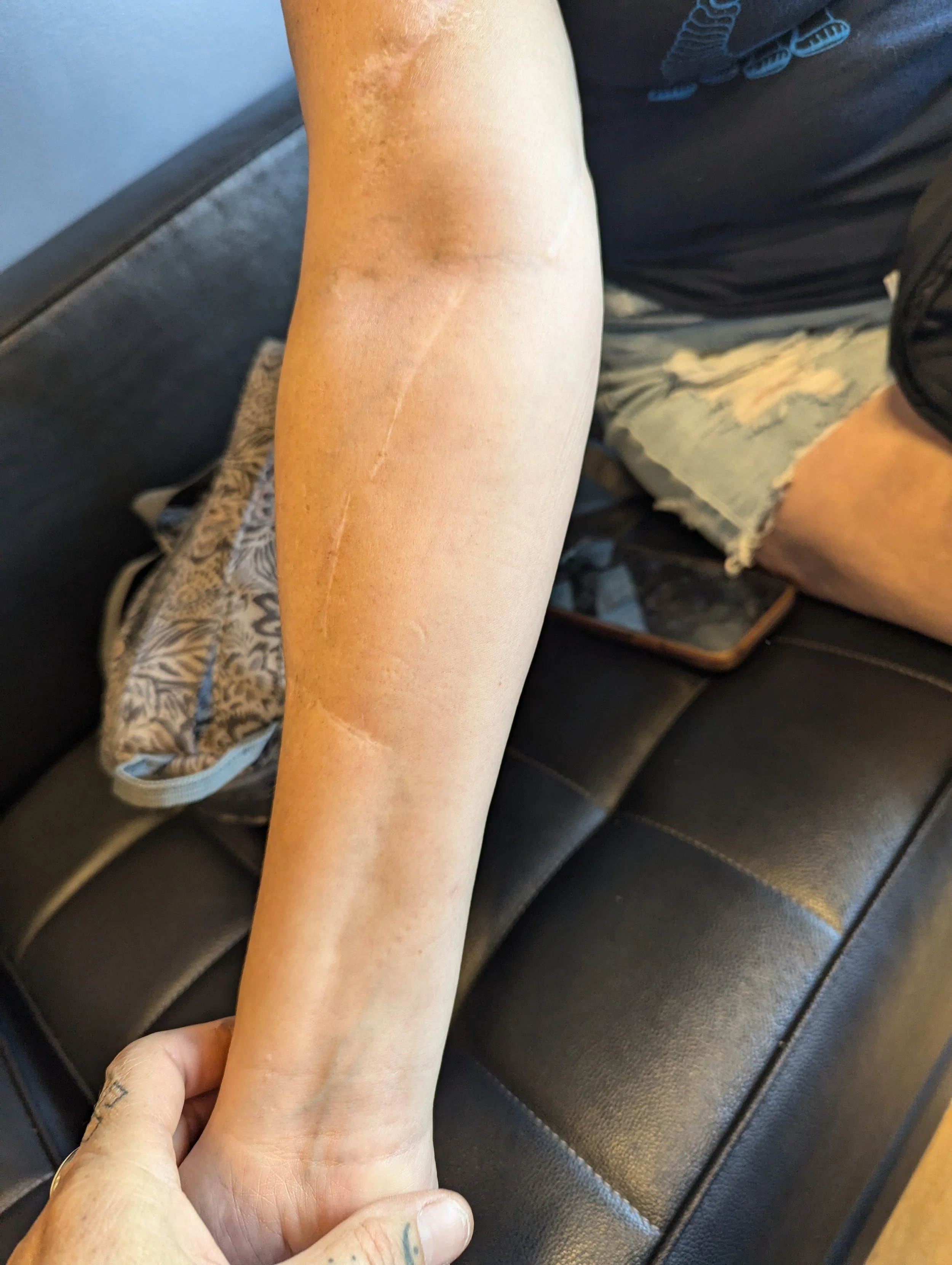 A person's arm with a fresh, long, pink scar running down the inner forearm.