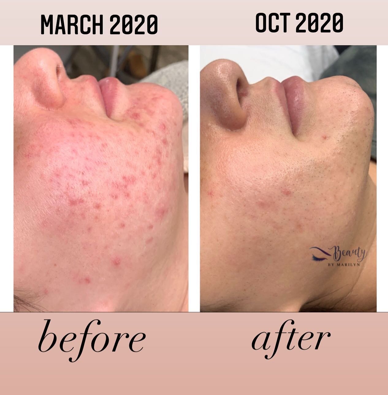Skin transformation. I&rsquo;m so happy with her skin journey! She had done a series of chemical peels with me and we changed up her skin care routine to better products that suit her skin type needs. #skincareproducts make such a big difference