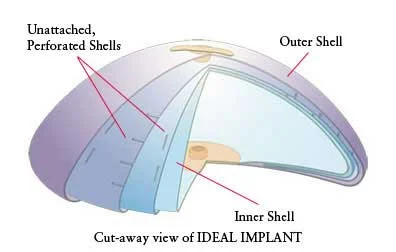 Thoughts On The "Ideal" Breast Implant