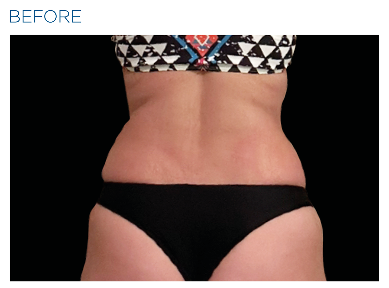 Emsculpt_Neo-Weight-Loss_PIC_Ba-card-female-lateral-abdomen-008_ENUS100.png