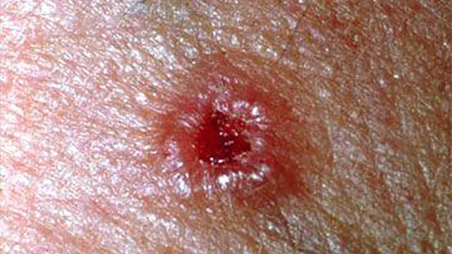 1459-Skin_Cancer-642x361-basal_cell_carcinoma.jpg