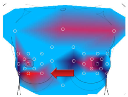 Thermography Scan showing breast blockages and compensating pathways that are over-used.