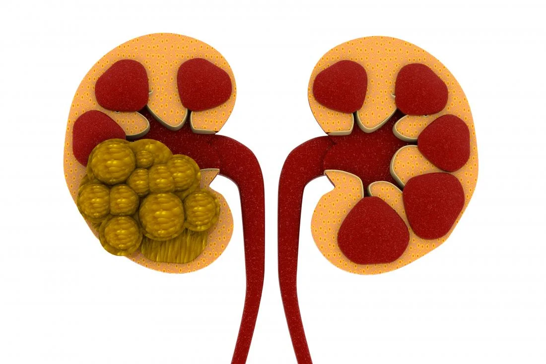 Kidney Stone Image.jpg