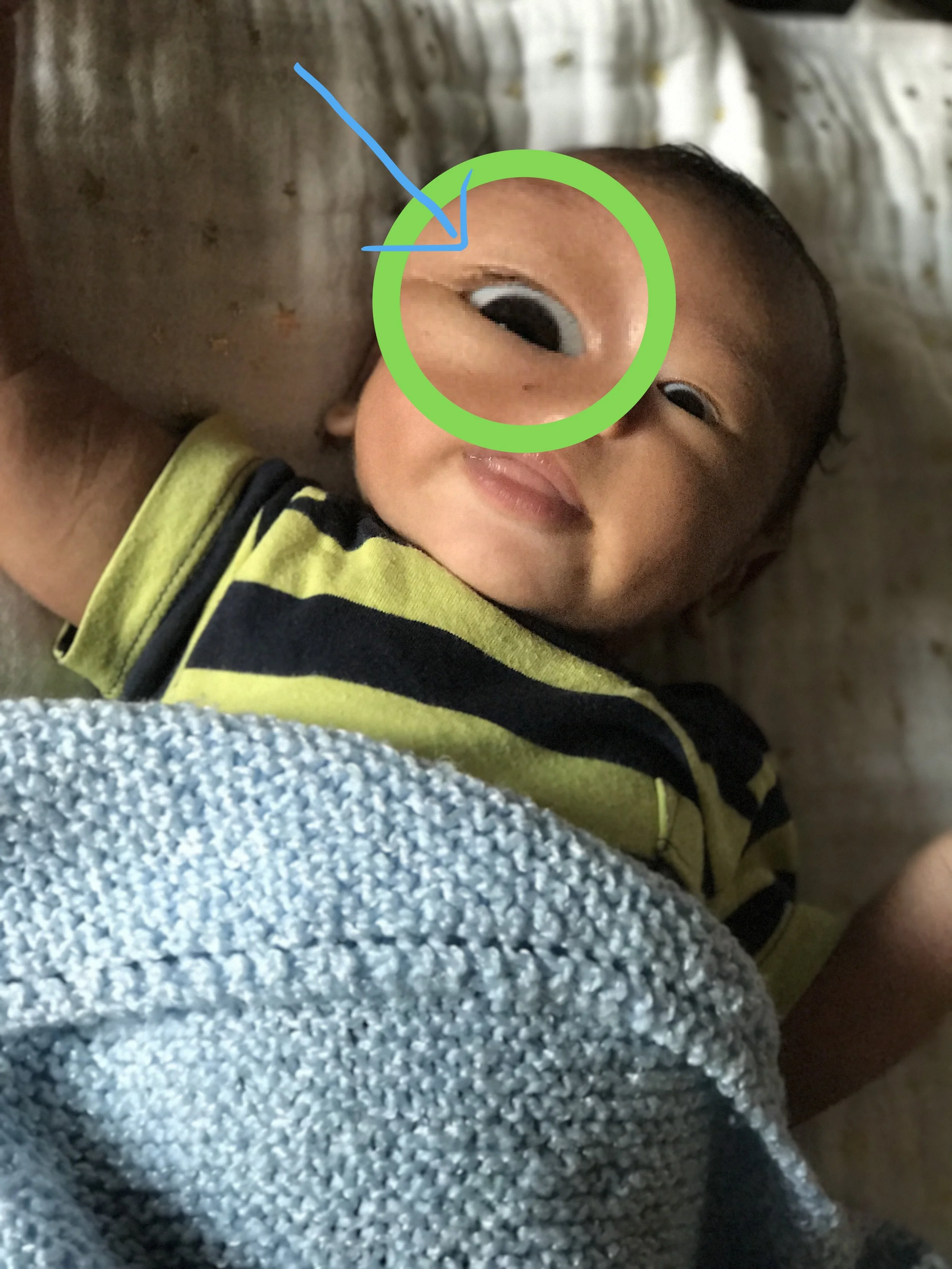 Double eyelid seen here with advanced iPhone technology.