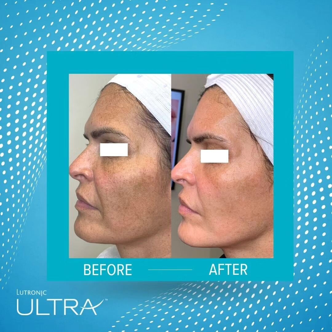 Six Sigma Beauty is proud to offer LaseMD Ultra by Lutronic, a cutting-edge skin rejuvenation technology from South Korea, the beauty hub of the world, that effectively targets various concerns such as sun spots, hyperpigmentation, melasma, acne scar
