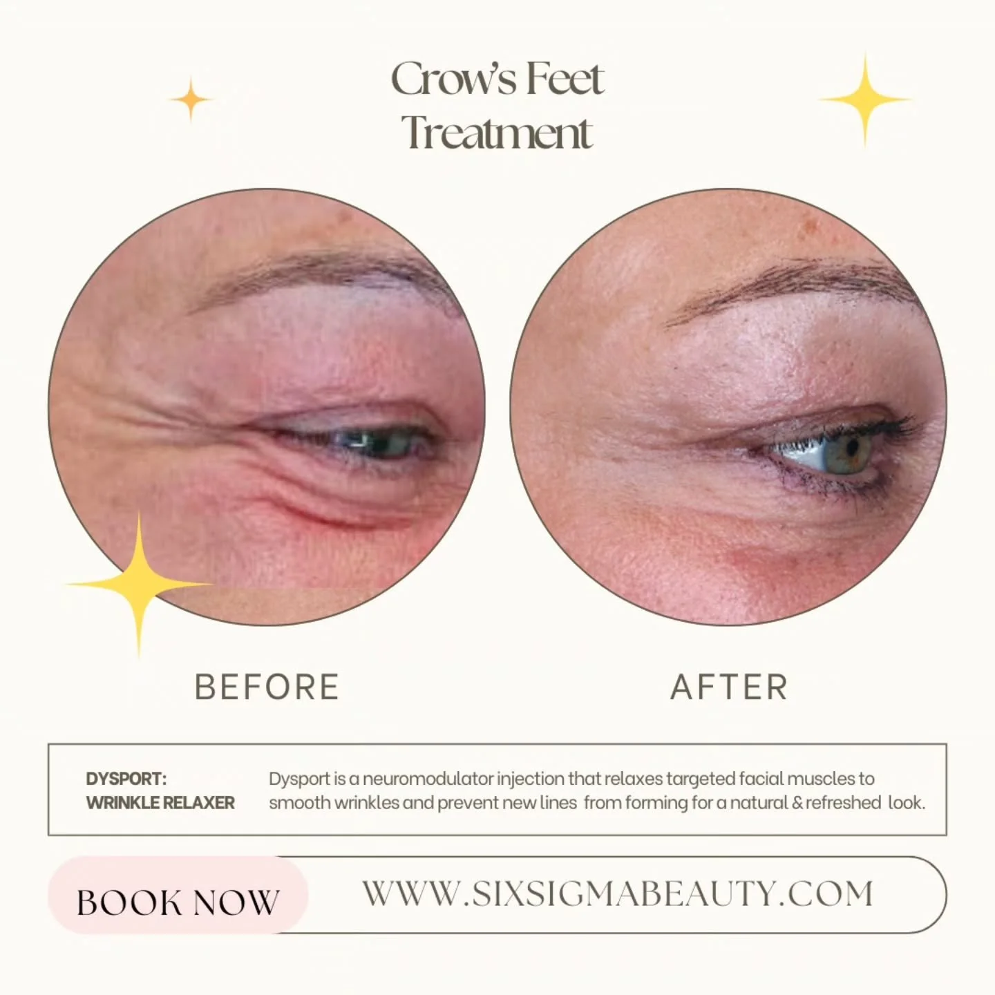 Erase the lines, keep the laughter- call us to book your crow&rsquo;s feet treatment 😘✨️ #crowsfeetdysport #medspact