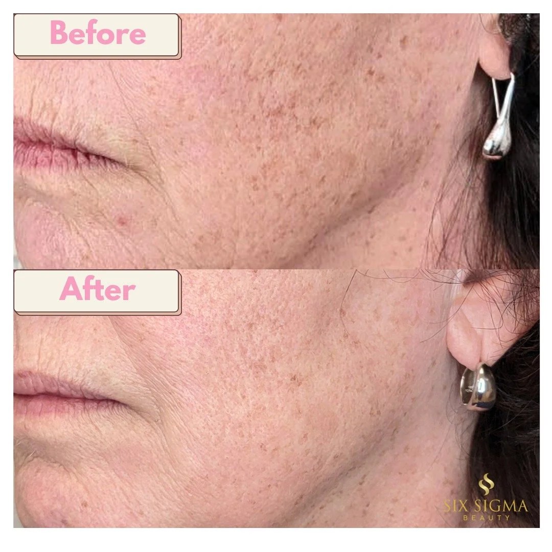 Check out this amazing real client result after just 2 sessions of our Glass Skin laser treatment! ✨ Don't forget to maintain your at-home skincare routine for the best results! We recommend Hydrinity Restorative HA serum to restore moisture from wit