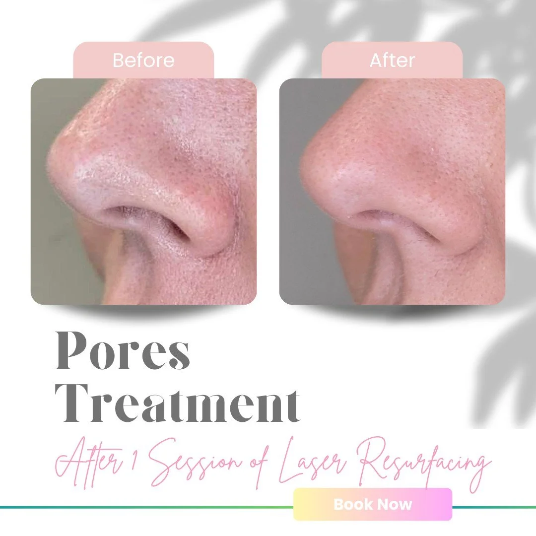 Summer may have been fun, but it left your pores clogged and skin thirsty? 🍂 Fall is the perfect time to refresh, renew, and shrink those pores with our laser resurfacing treatments. We can help you get your radiant glow just in time for sweater sea