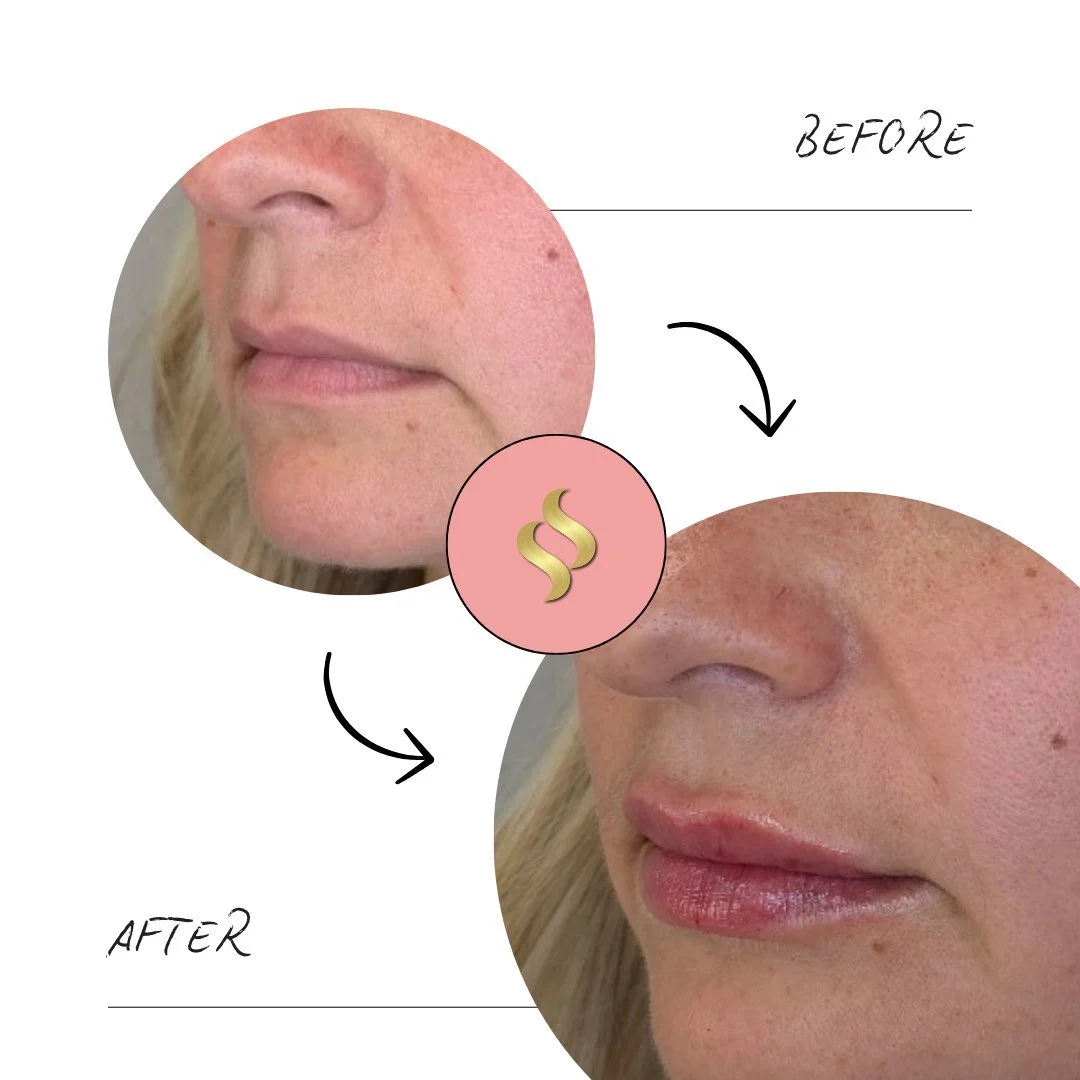 Gloss can't fake what filler refines.  Smooth, soft, and subtle ✅