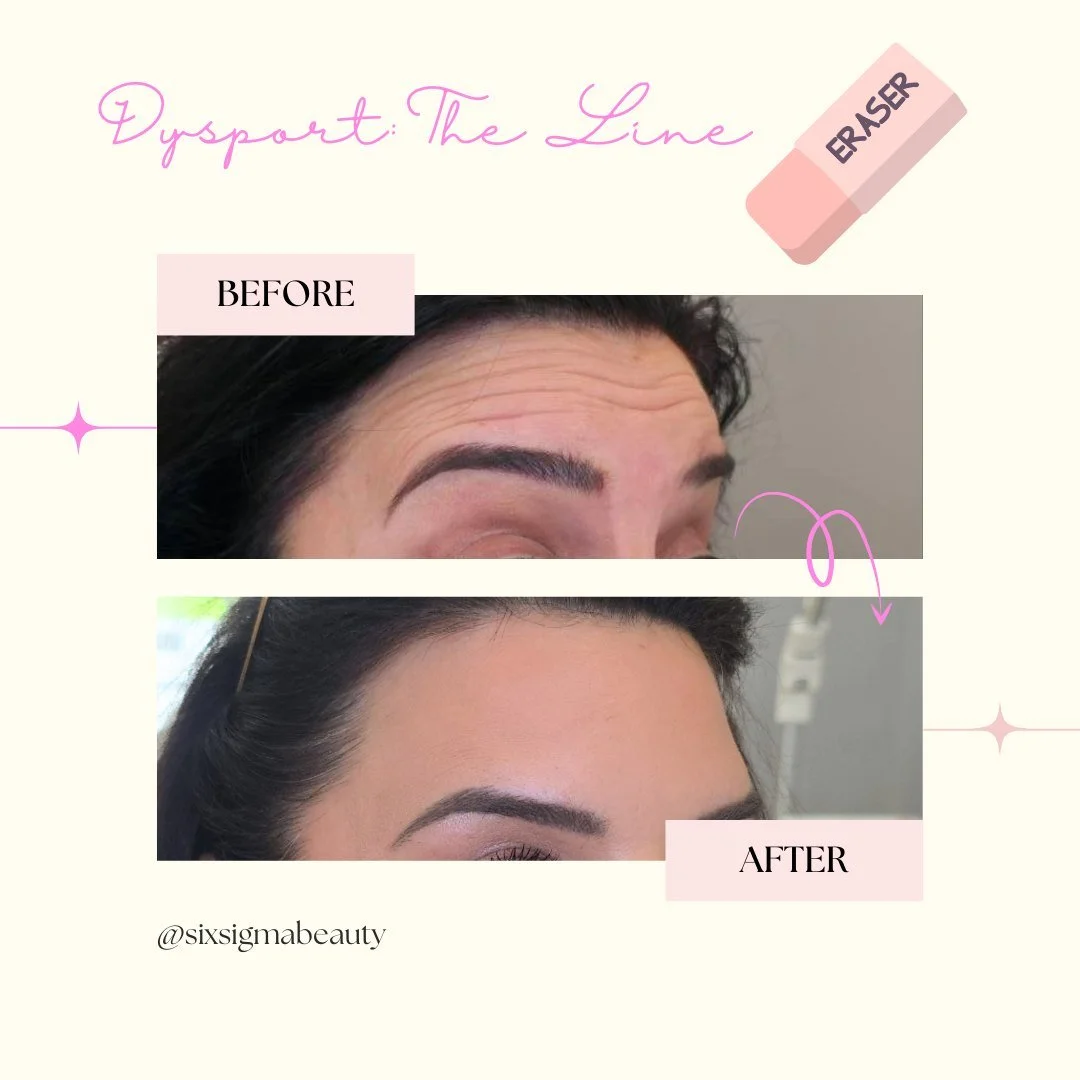 🍂 Fall is here, and so are the lines that summer left behind! Dysport works fast, looks natural, and keeps you glowing for the holidays ahead. Book your refresh now and step into the season wrinkle-free ✨

Dysport&reg; Facts:

Dynamic Wrinkle Fixer 