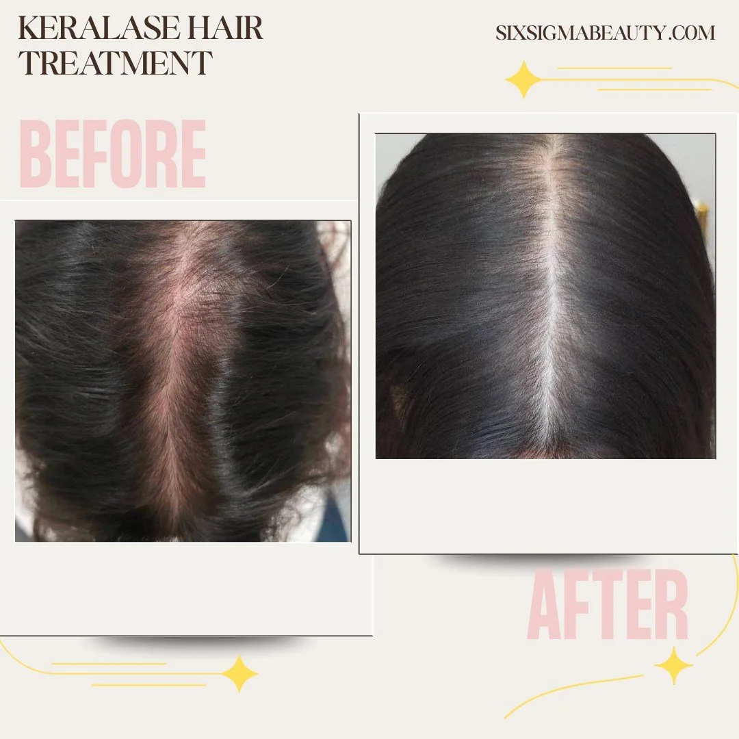 Healthy Hair Starts with a Healthy Scalp! ✨

Keralase Hair Treatment uses laser energy from LaseMD Ultra to create micro-channels in the scalp, allowing KeraFactor Growth Serum to deeply penetrate where it counts most!

Benefits: 
- Boosts circulatio