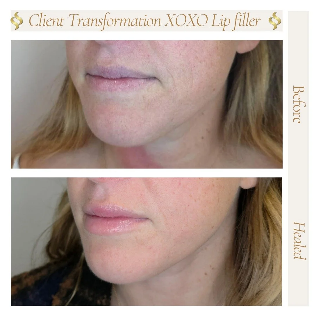 Things to definitely NOT DO after fresh lip filler:

💋 NO smoking/vaping
💋 NO kissing
💋 NO lipstick/makeup
💋 NO sun exposure
💋 NO putting pressure on your lips (such as sleeping on your stomach or side)
💋 NO sucking straws...scratch that, no su