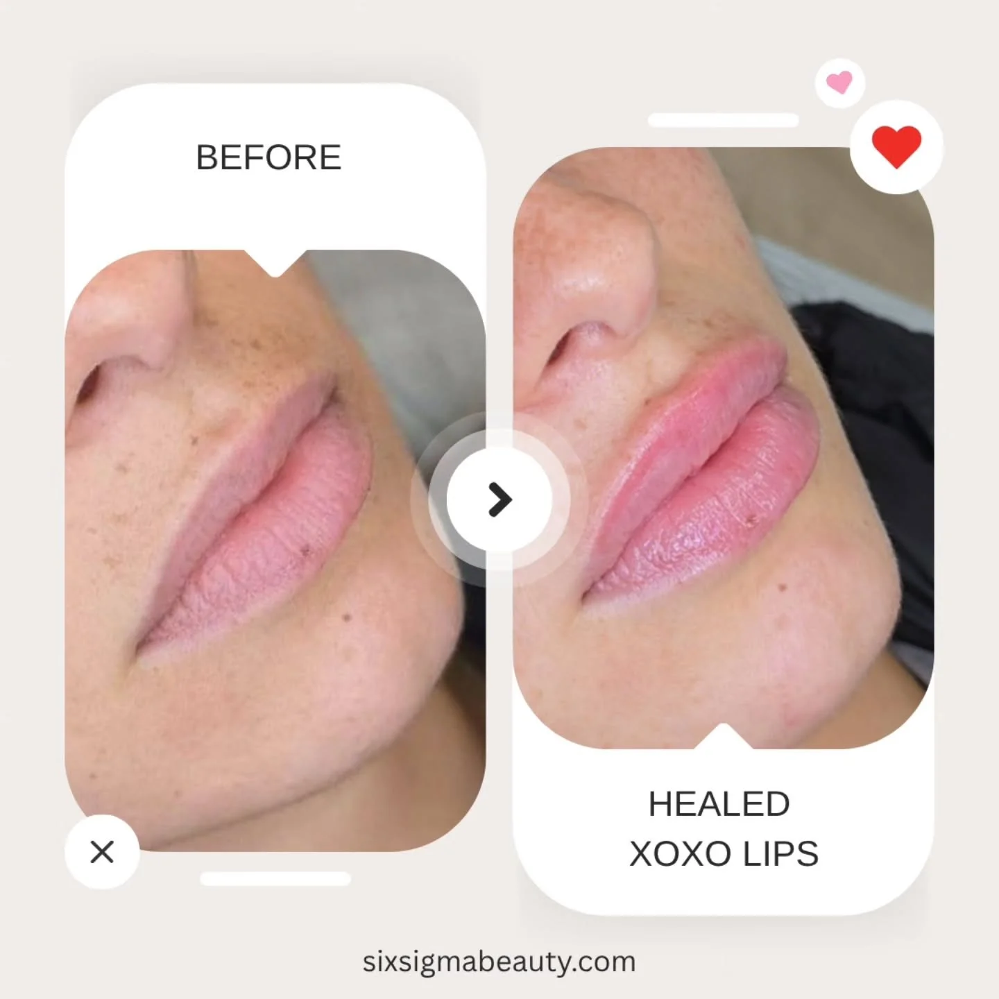 Healed lips loading&hellip; please admire responsibly 💋💉
All services performed by Dr. Tr&uacute;c Vuu, APRN.

SIX SIGMA BEAUTY
SOUTHINGTON,  CT
860-202-2815
