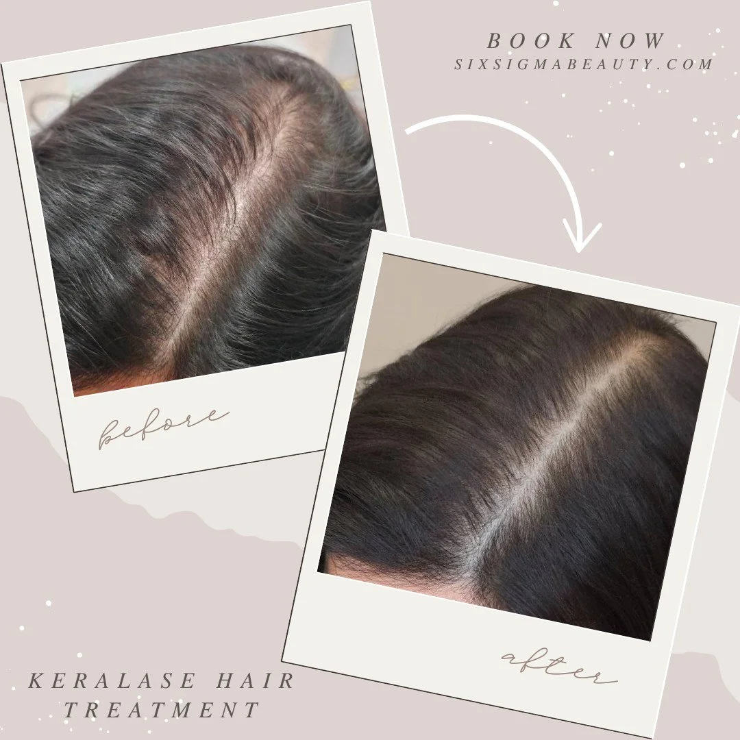 Thicker hair starts with our KeraLase Hair Treatment, a combination of our LaseMD Ultra laser and KeraFactor Hair Growth Serum, which includes PDRN, Sh-Oligopeptide-1, and Copper Tripeptides to rejuvenate the scalp and stimulate hair follicle activit