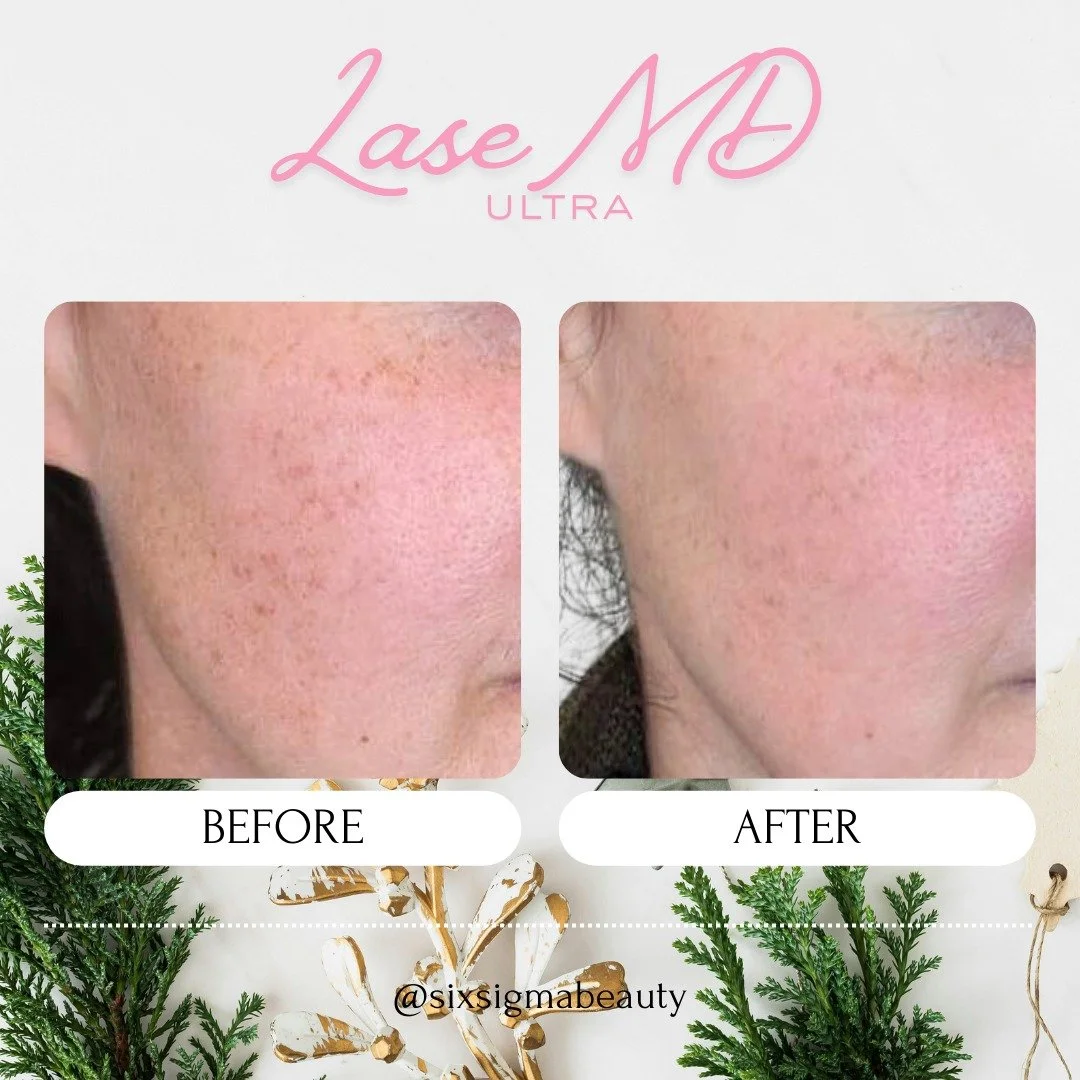 Holiday Glow Up 🎄

LaseMD Ultra is an exceptional non-ablative fractional laser treatment that utilizes a powerful 1927nm wavelength to effectively resurface skin, stimulate collagen, and significantly improve texture, tone, fine lines, dark spots, 