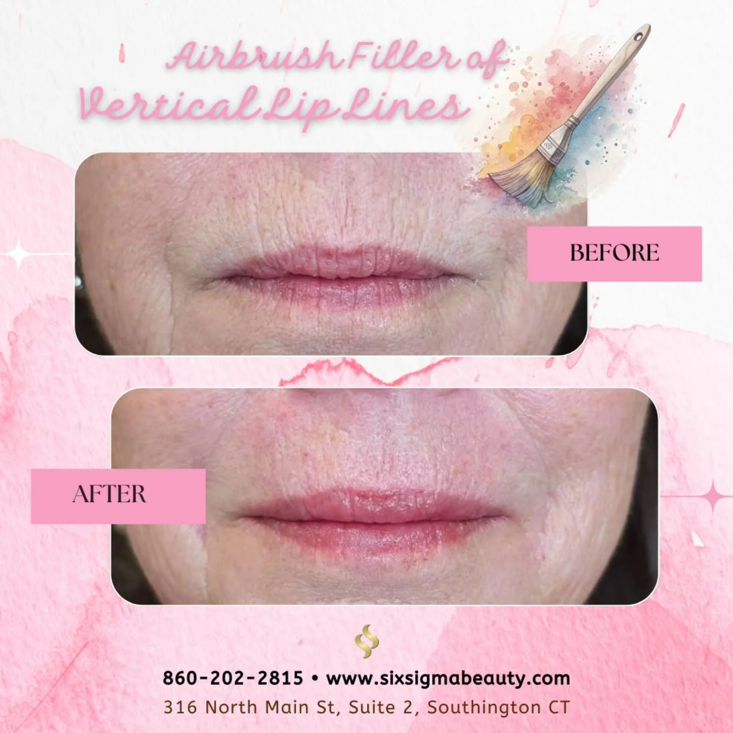 Vertical lip lines? Airbrushed.
Dry lips? Hydrated.
We don't overfill. We edit.
Tea is hot, lines are not 🍵✨️