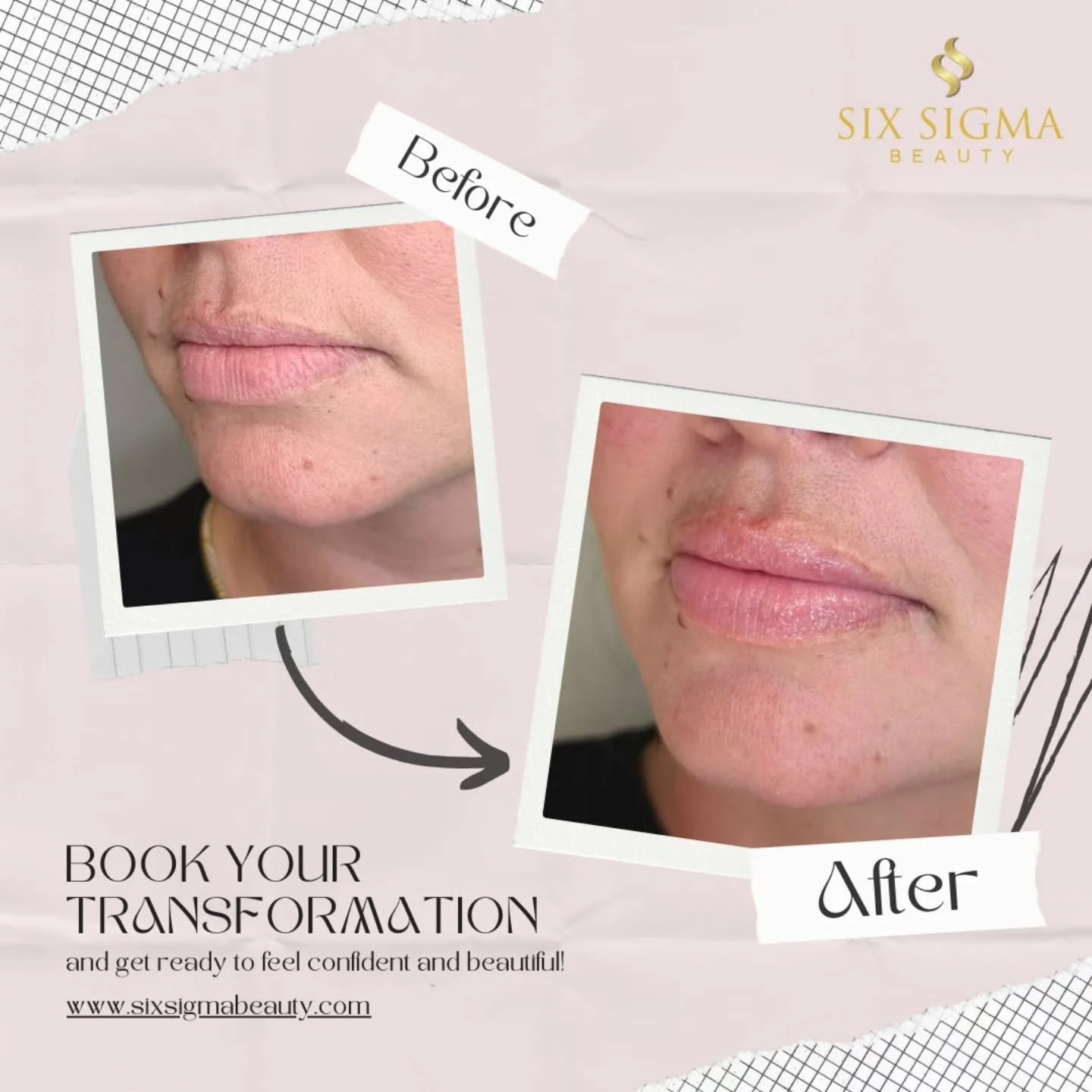 Half a syringe. Whole new vibe 💋 #lipfillerbeforeandafter #healedlips