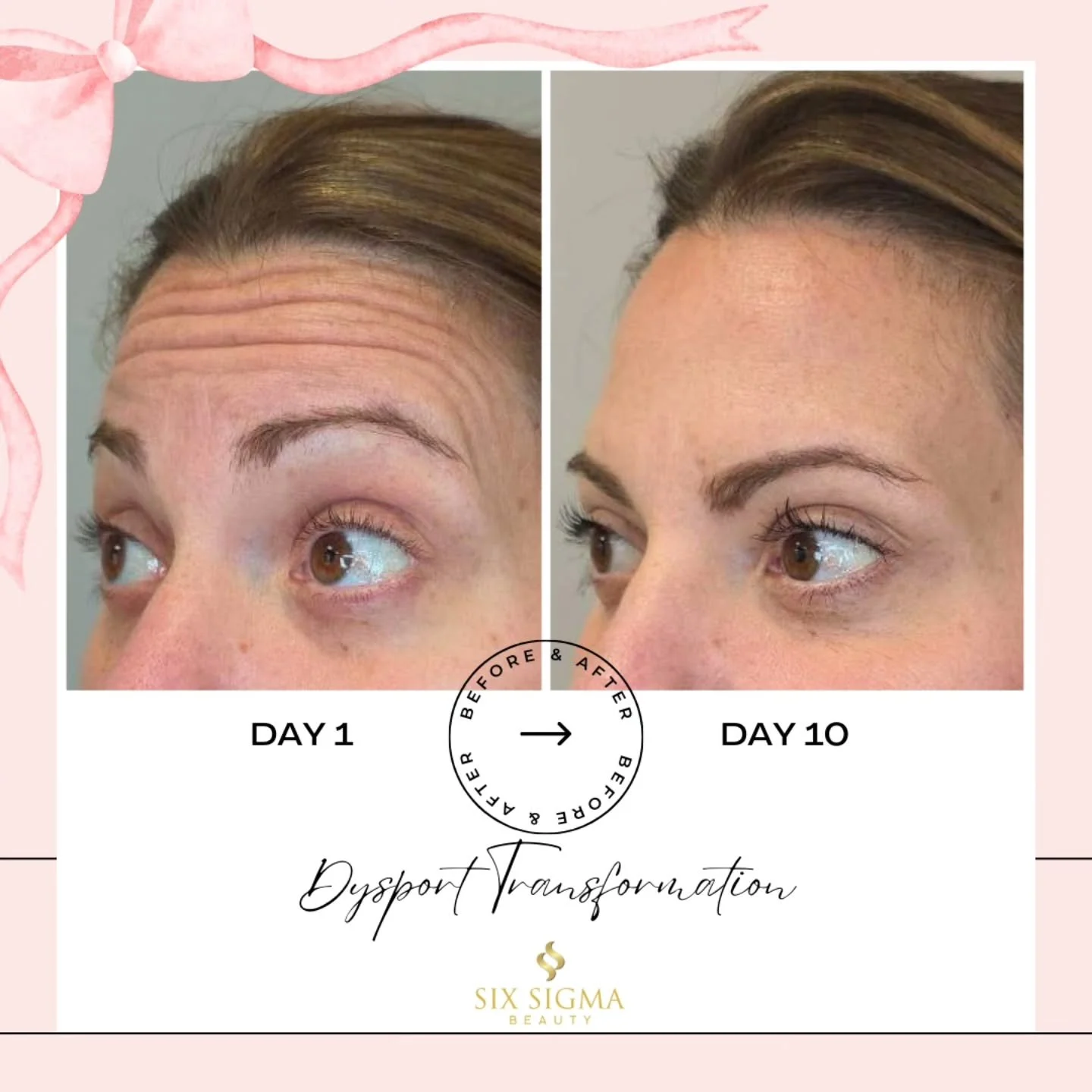 This is the kind of before and after where people ask about your skincare routine, not your injector (please drop our name though!) 💉✨️ #dysport 

⭐️⭐️⭐️⭐️⭐️
SIX SIGMA BEAUTY
Boutique Medspa
316 N Main Street, Suite 2
Southington CT 06489
(860) 202-