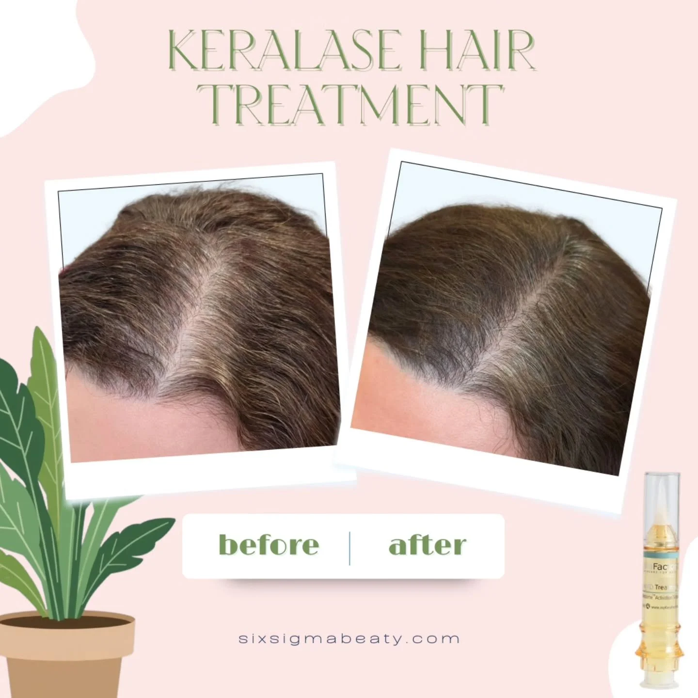 6 Keralase sessions in and the hair growth results speak for themselves. 

At home care: Kerafactor Shampoo and Conditioner, Kerafactor Hair Growth Serum, and nightly red light therapy to maximize results 🌱

Anyone else on their Keralase journey? @k