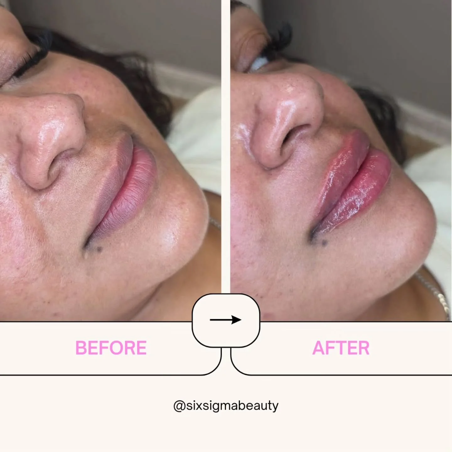 TGIF: Truc Gives It-Girl Filler 💋 

⭐️⭐️⭐️⭐️⭐️
SIX SIGMA BEAUTY
Boutique Medspa
316 N Main Street, Suite 2
Southington CT 06489
(860) 202-2815 
sixsigmabeauty.com