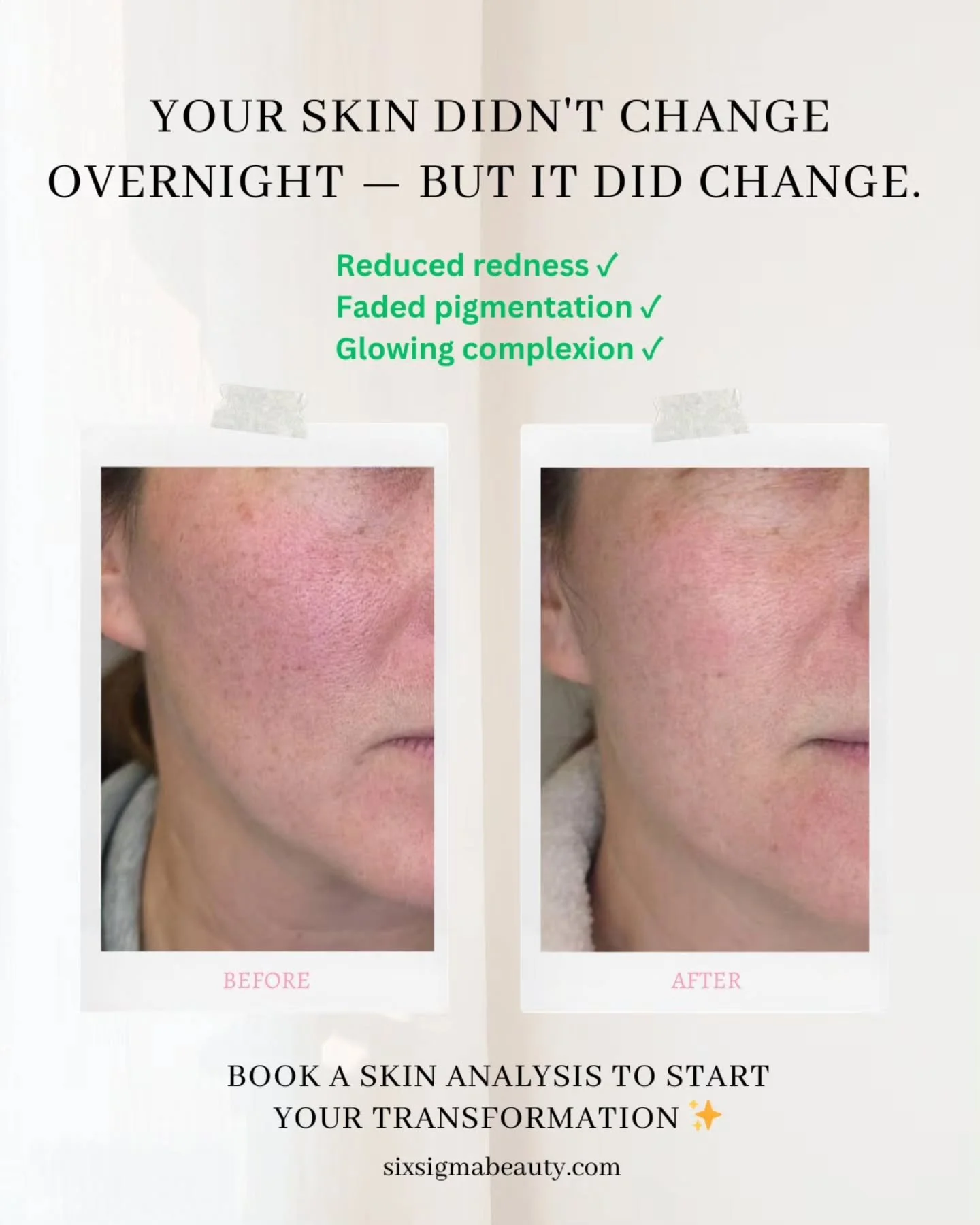 Imagine waking up and loving what you see in the mirror. Smoother. Calmer. Brighter. No filters needed!

Real results. Real skin. Real transformation. Your glow-up is waiting ✨️

Book your skin analysis today at sixsigmabeauty.com.

⭐️⭐️⭐️⭐️⭐️
SIX SI