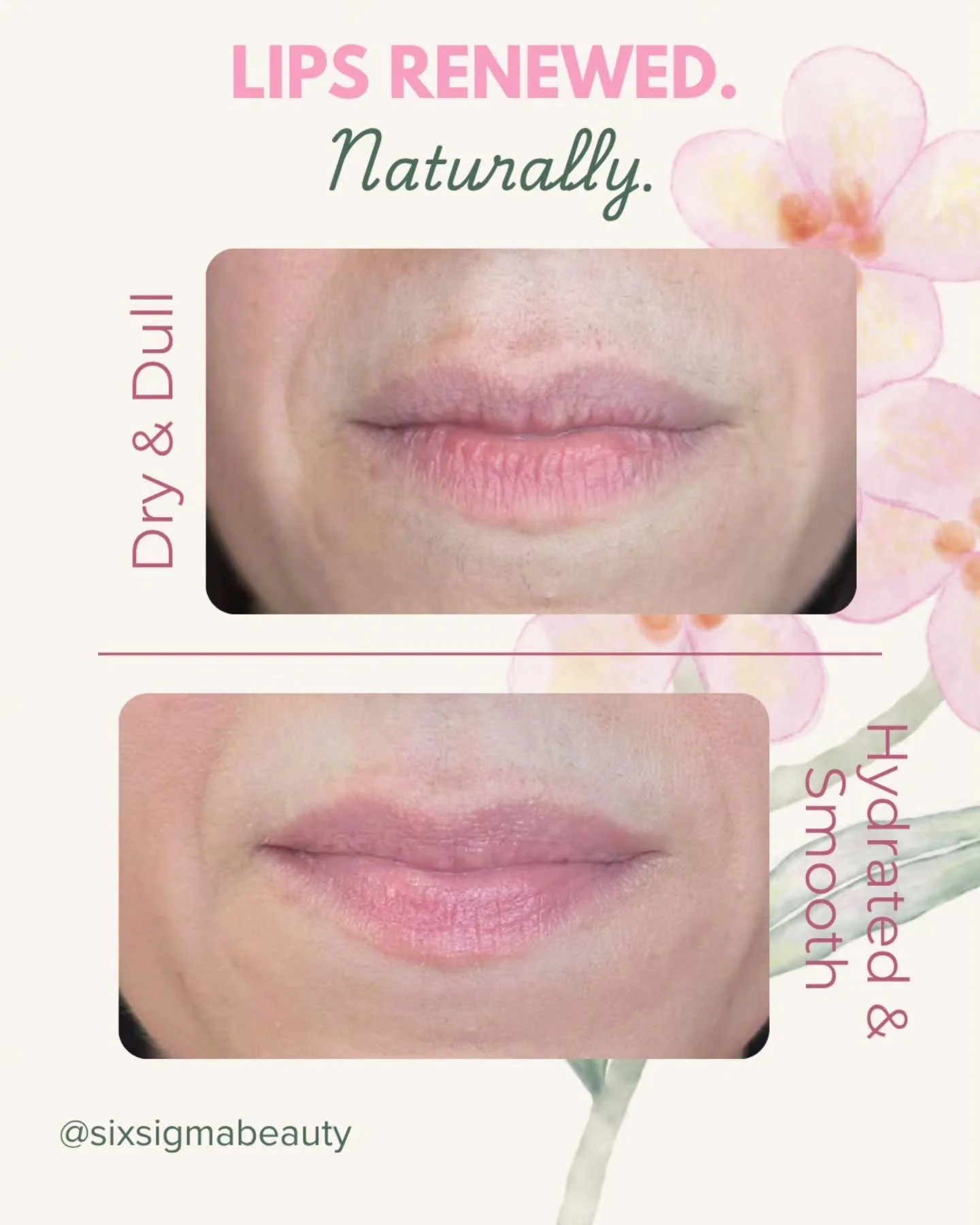 Dry. Lined. Dull. ➡️ Renewed. Smooth. Radiant.
This is what 2 LaseMD Ultra treatments did for her lips. By stimulating your own collagen, we're not masking the signs of aging - we're reversing them. Naturally.

Book Lips Renewed Ritual- link in bio ?
