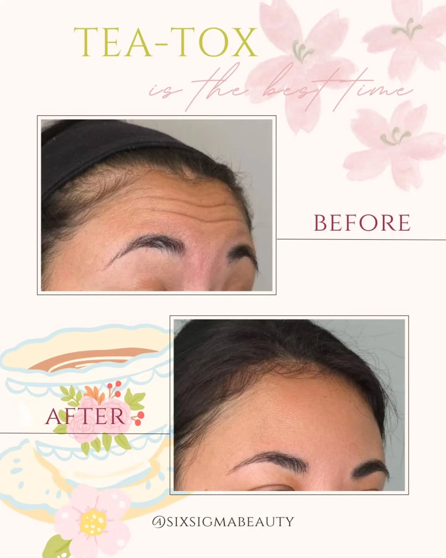 Picture this 🌷 You arrive, you're welcomed into our serene, beautifully curated space. A warm cup of tea is placed in your hands. Soft music, gorgeous ambiance, zero stress. 

And while you sip and unwind, Dysport quietly erases those forehead lines