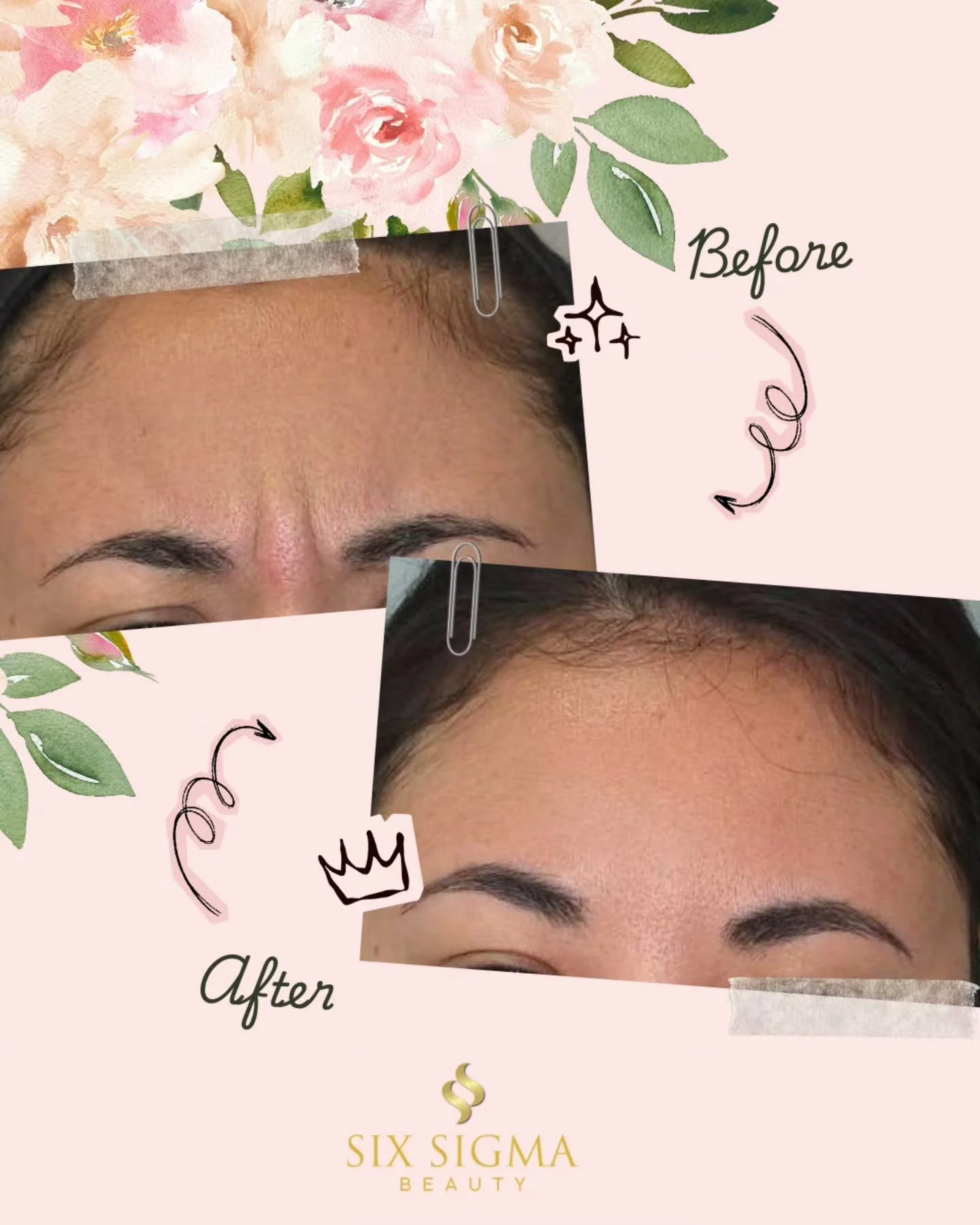 Those frown lines between your brows? Gone. This is what Dysport can do - soften the deep lines that show up even when you're actively frowning, so your face finally matches how you actually feel inside.

Refreshed. Natural. Still 100% you ✨

Results