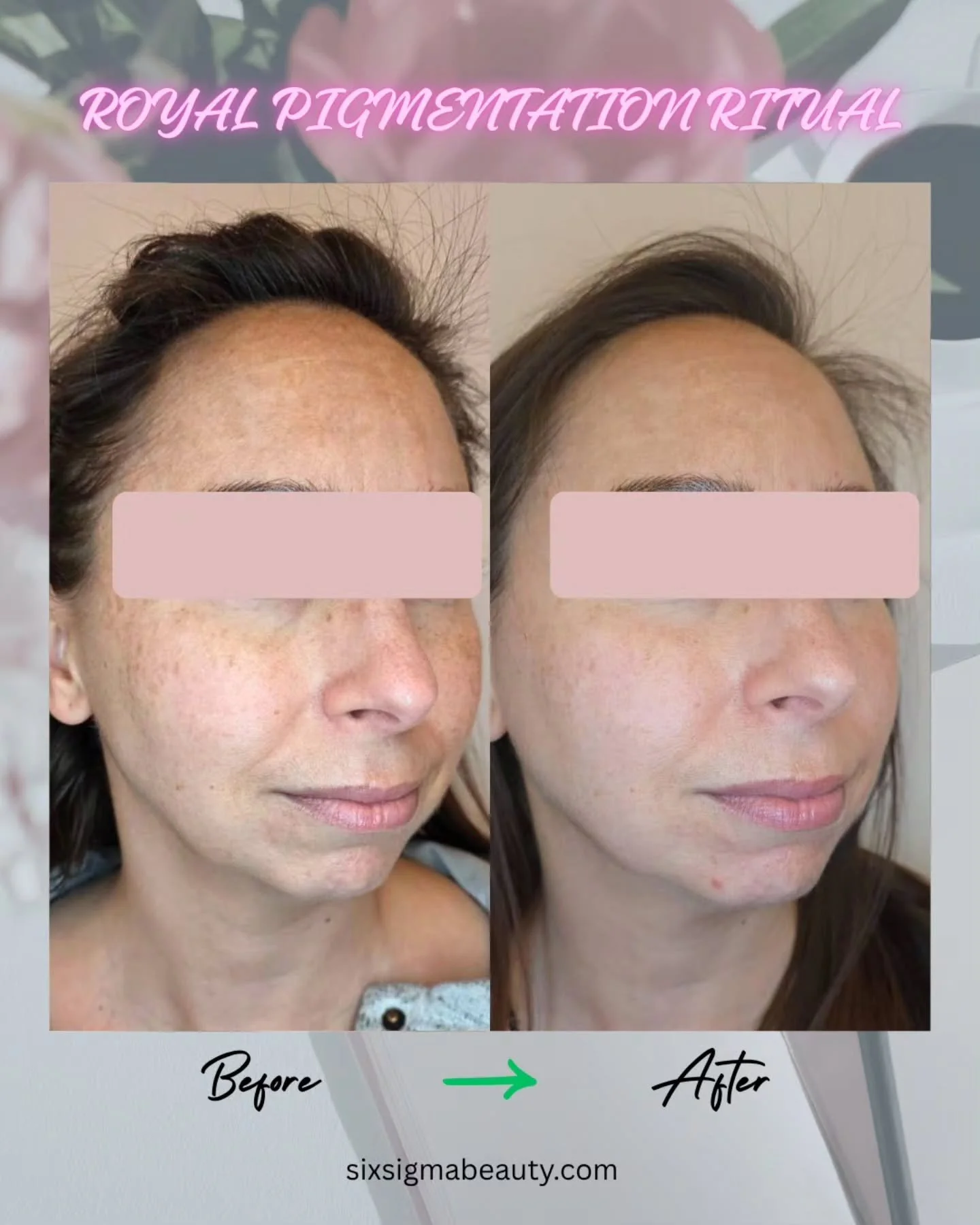✨ Your dark spots don't stand a chance ✨

This is what happens when we combine LaseMD Ultra + Tranexamic Acid in our Royal Pigmentation Ritual &mdash; and the results speak for themselves. Before and after shows 30 days result after just ONE session!