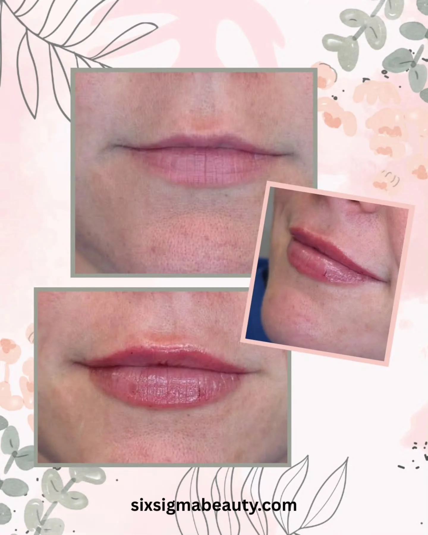 Lip filler | Asymmetry correction + volume balance 💉

This client presented with a lower right cupid's bow compared to the left, along with a disproportionate upper-to-lower lip ratio. Treatment goals for session one:

✔️ Elevate the right cupid's b