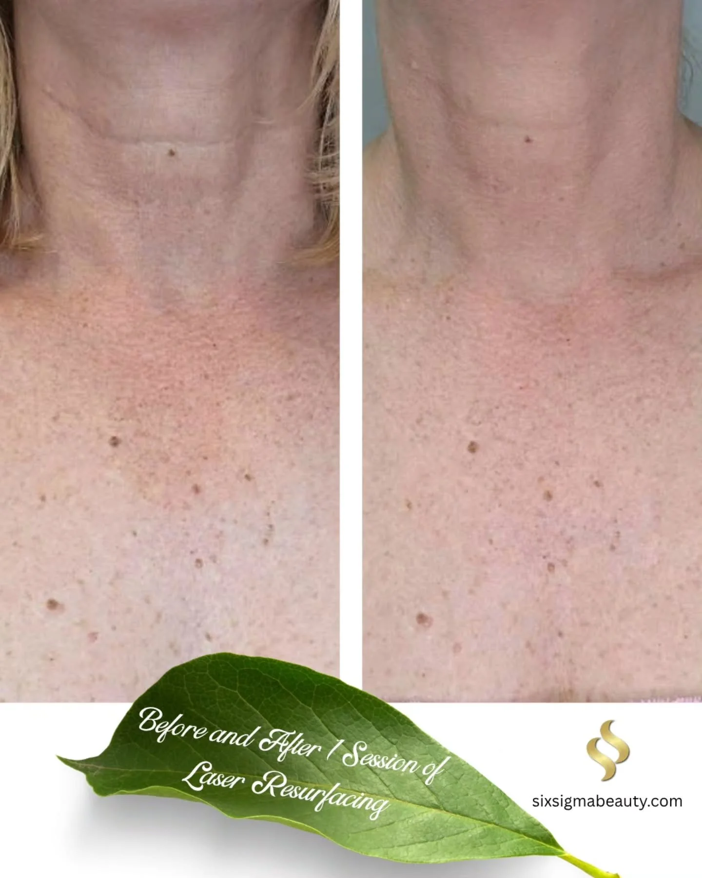 She's only 1/3 of the way there but look at her neck &amp; chest already! 

This client came to us wanting to address years of sun damage, texture, and pigmentation on her neck and chest &mdash; and *this* is just the beginning.

After a single Laser