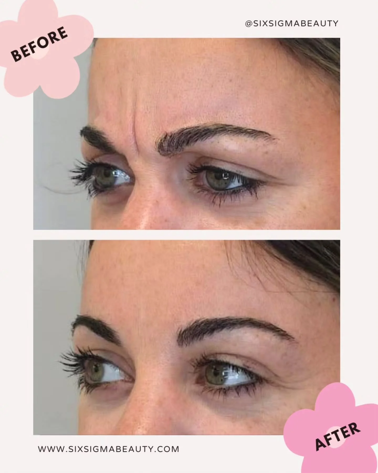 Deep frown line. Two words: NOT ANYMORE 💥

She'd been told it 'just wouldn't budge.' We said hold our Dysport 💉✨

After listening to her concerns and customizing her Dysport treatment &mdash; LOOK AT THOSE RESULTS AFTER 10 DAYS 🙌

No more 11s. No 